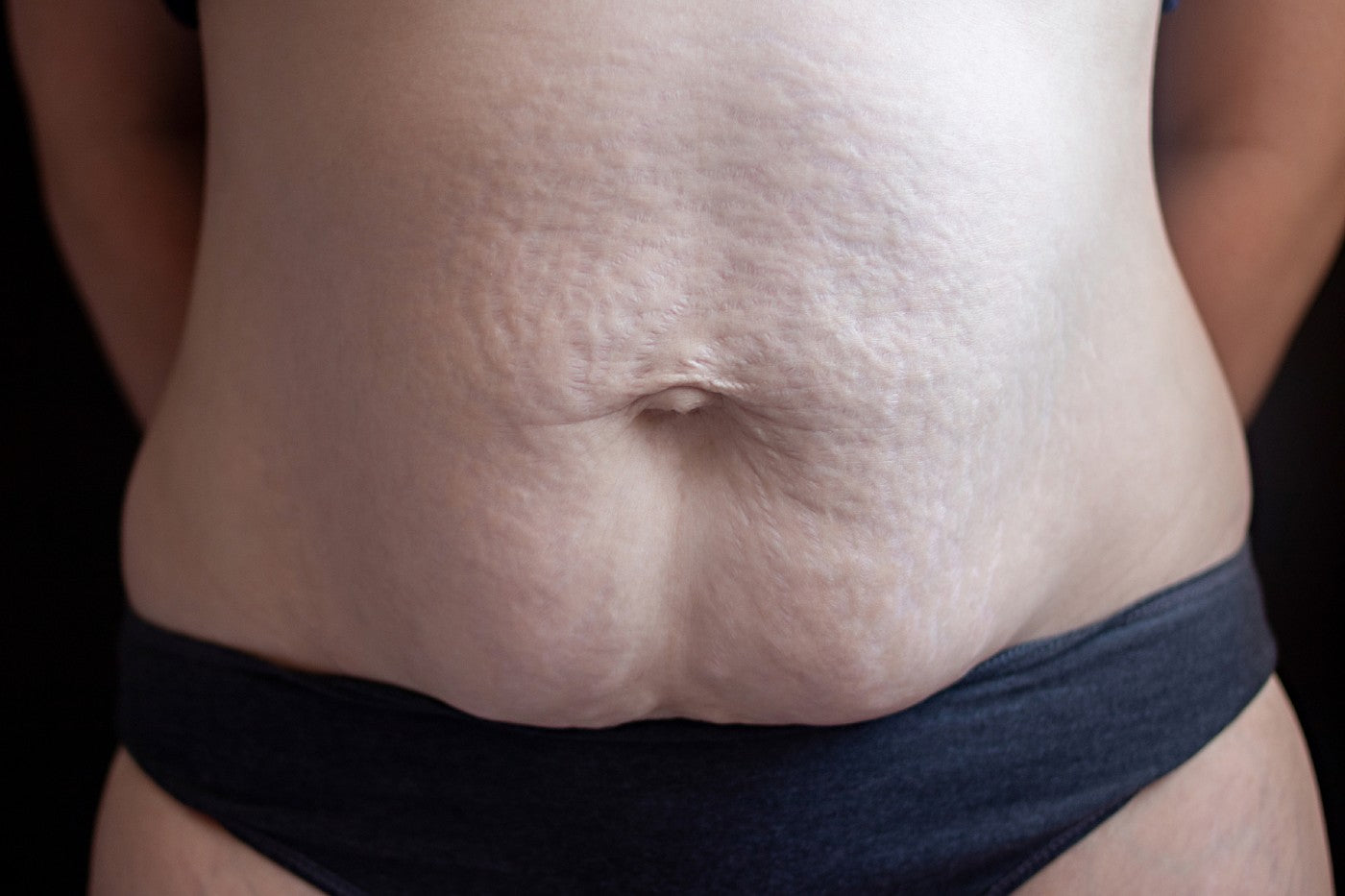 A view from umbilical hernia accompanied by diastasis recti and