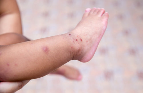 Hand-Foot-Mouth Disease: What Parents Need to Know